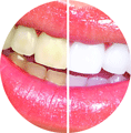 Tanden bleek voor en na